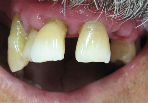 doença periodontal - doença purpura